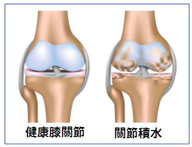 膝關節積水